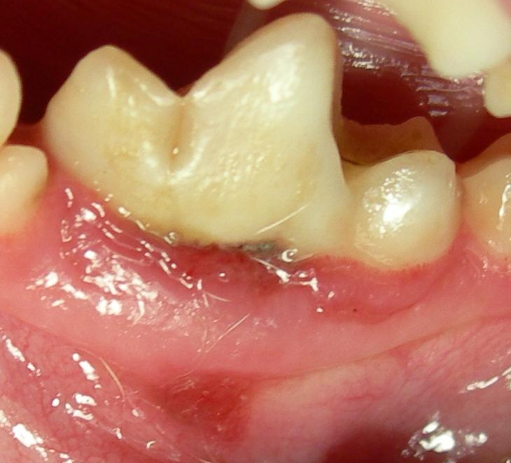Abcess on molar with some evidence showing at gumline
