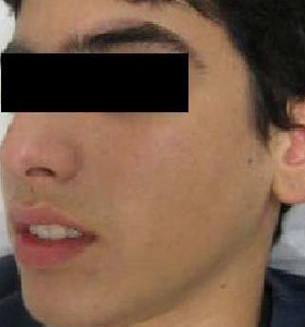 https://0901.nccdn.net/4_2/000/000/008/486/acne_after_Skin-Type-4-Number-of-Treatments-8-280x300.jpg