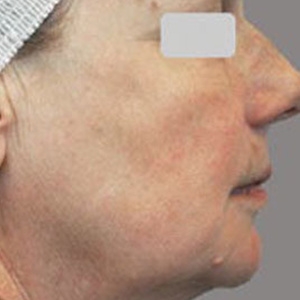https://0901.nccdn.net/4_2/000/000/010/19b/skin_rej_after-300x300.jpg