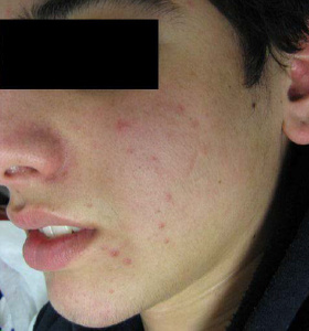https://0901.nccdn.net/4_2/000/000/017/e75/acne_Skin-Type-4_before-280x300.jpg