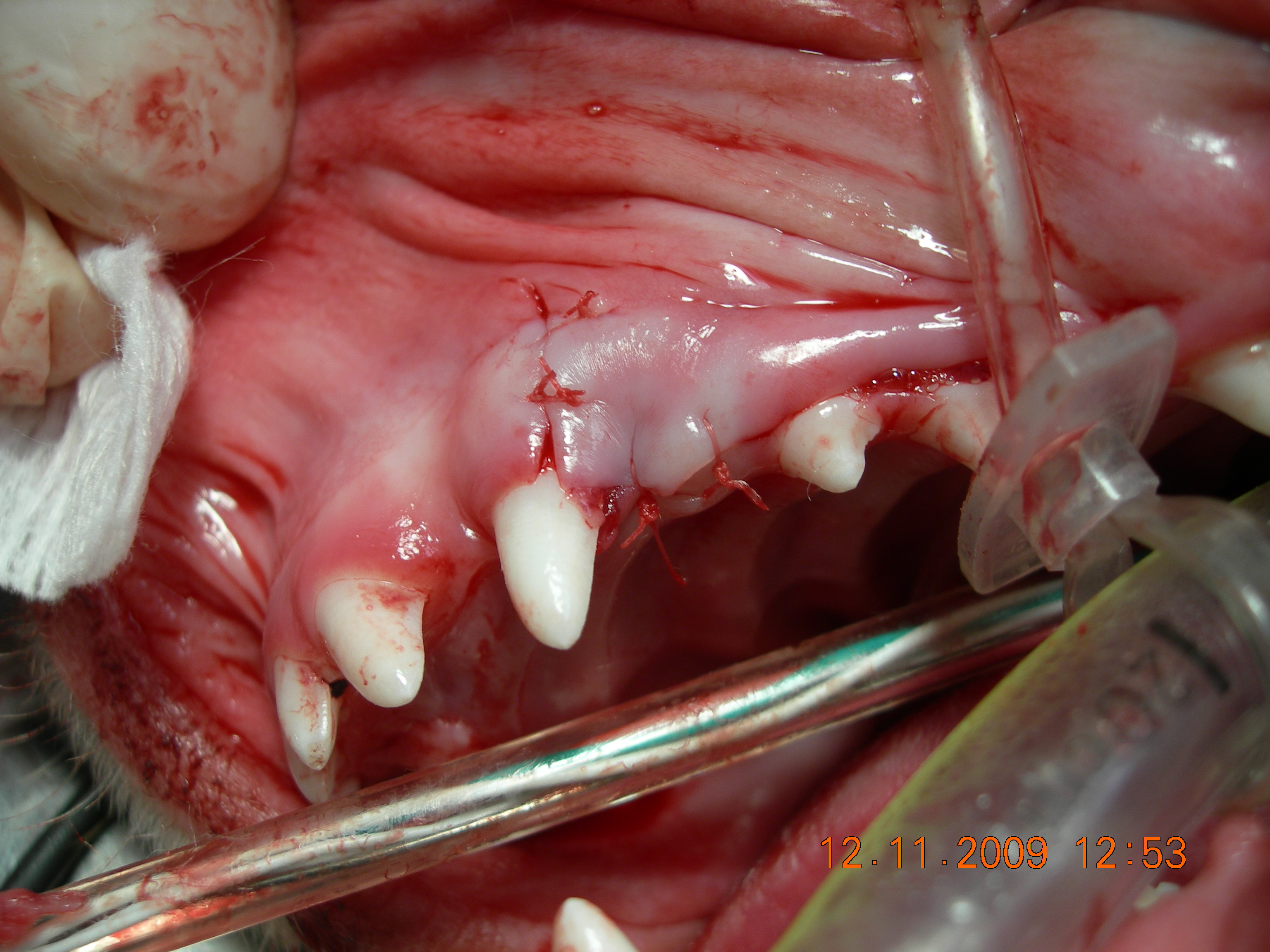 Surgical extraction required, in process of suturing gum flap back in place