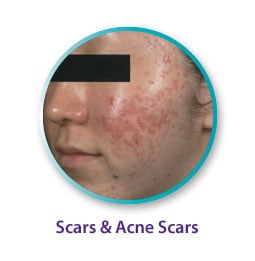 Scars & Acne Scars