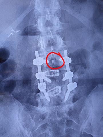 Neck x-ray showing new bone growth and hardware before removal. Neck x-ray showing new bone growth and hardware before removal.