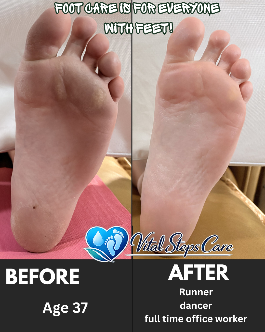 https://0901.nccdn.net/4_2/000/000/03f/ac7/calloused-soles-and-great-toe.png