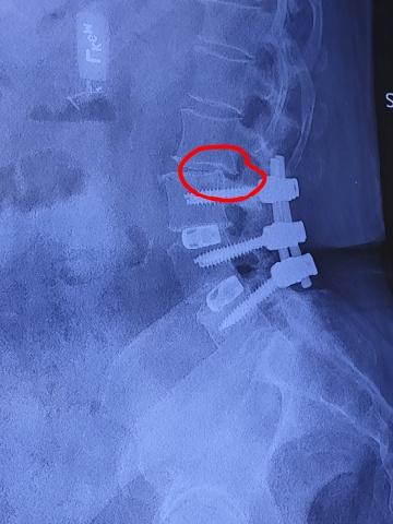 Profile neck x-ray showing new bone growth and hardware before removal.