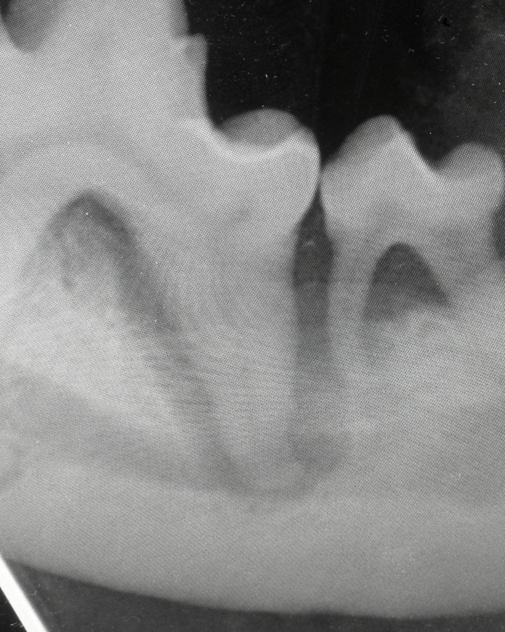 Xray showing bone loss around the rooth due to ongoing infection