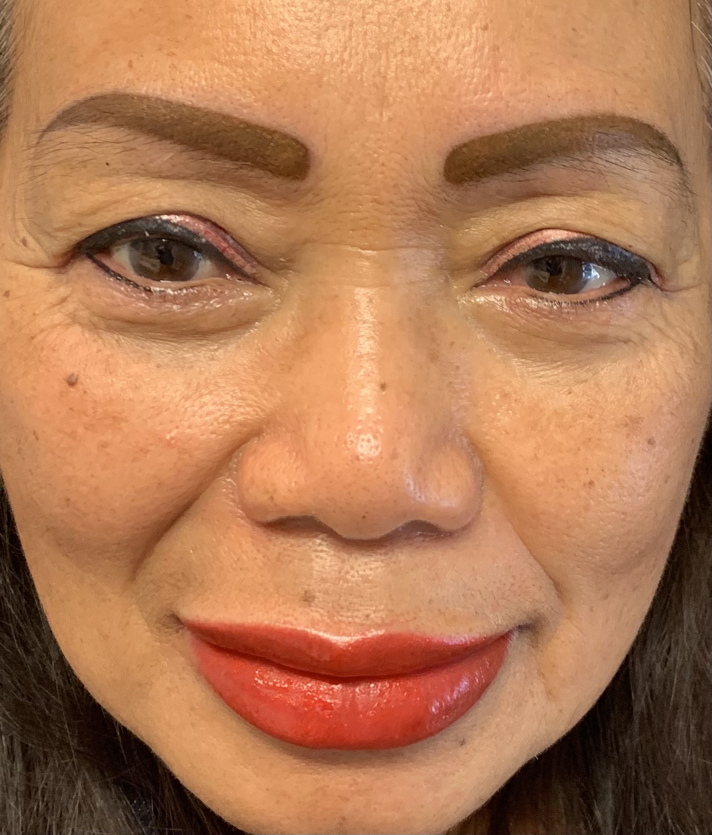 Whole face that is still swelling after procedure 