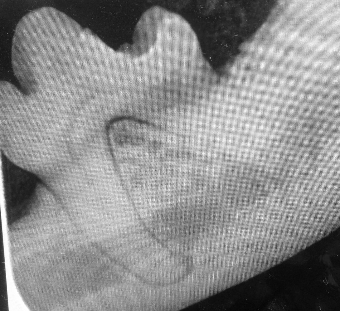 An unusual "healing" of the periodontal infection. Very rare! Usually results in tooth loss