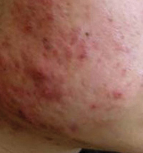 https://0901.nccdn.net/4_2/000/000/064/d40/acne_type1_before-280x300.jpg