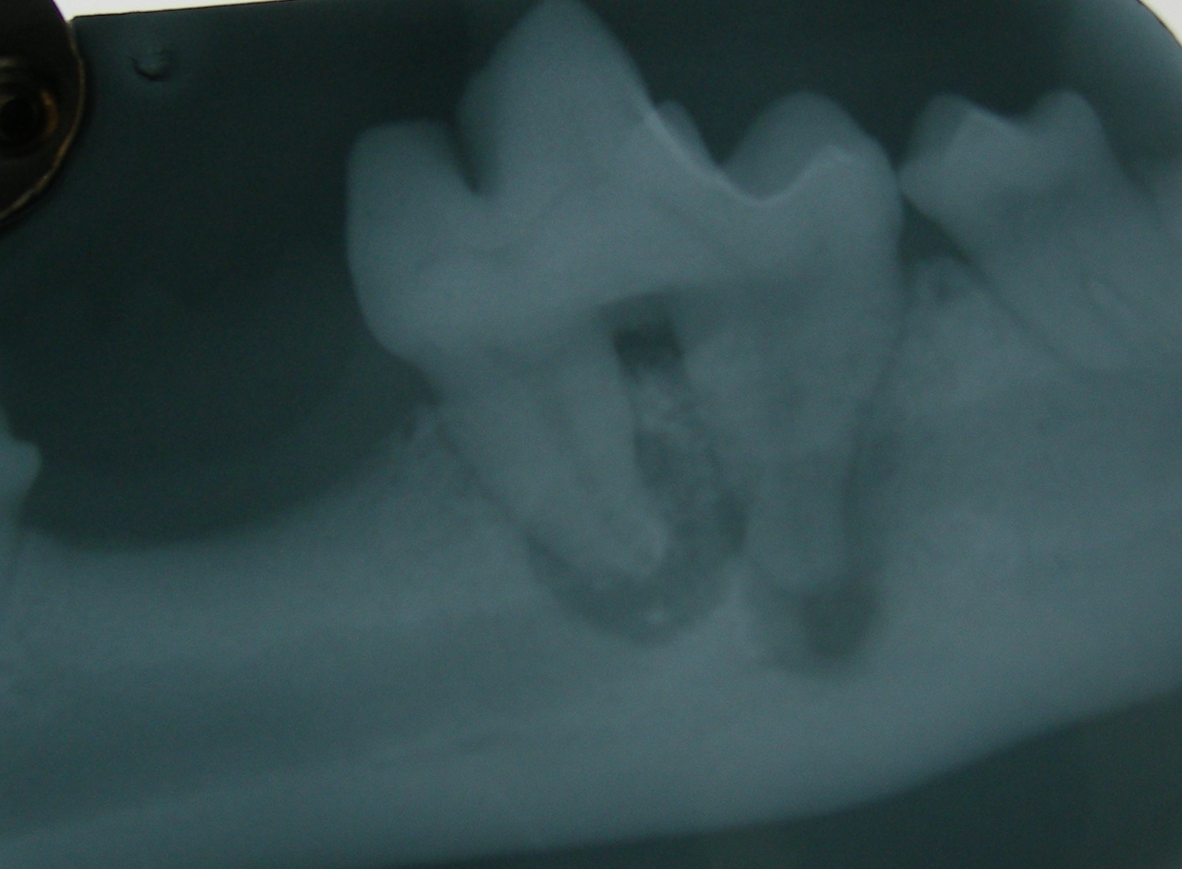 Xray of abcess on molar of lower jaw