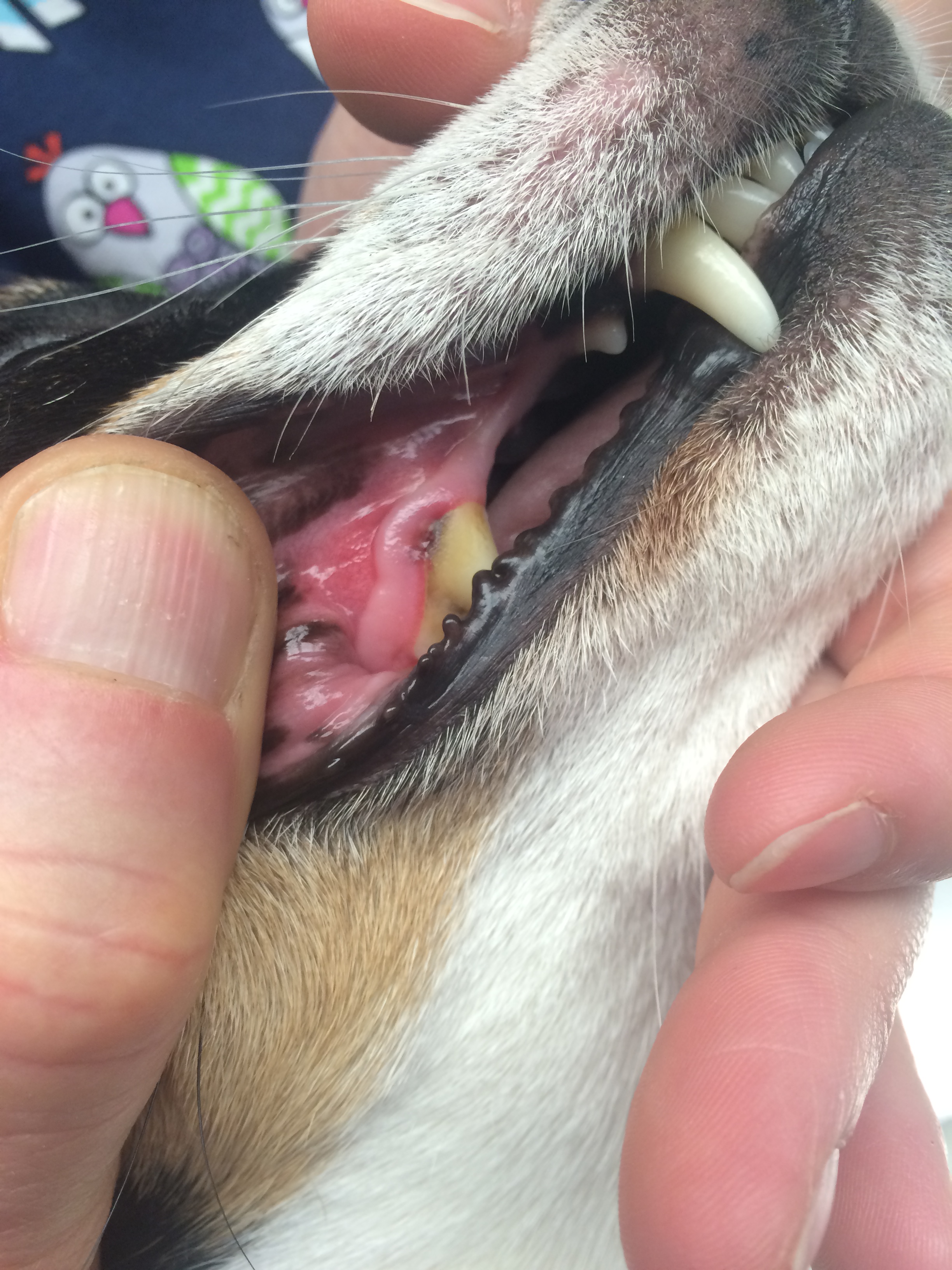 This gingivitis was associated with a sliver in the gum pocket.