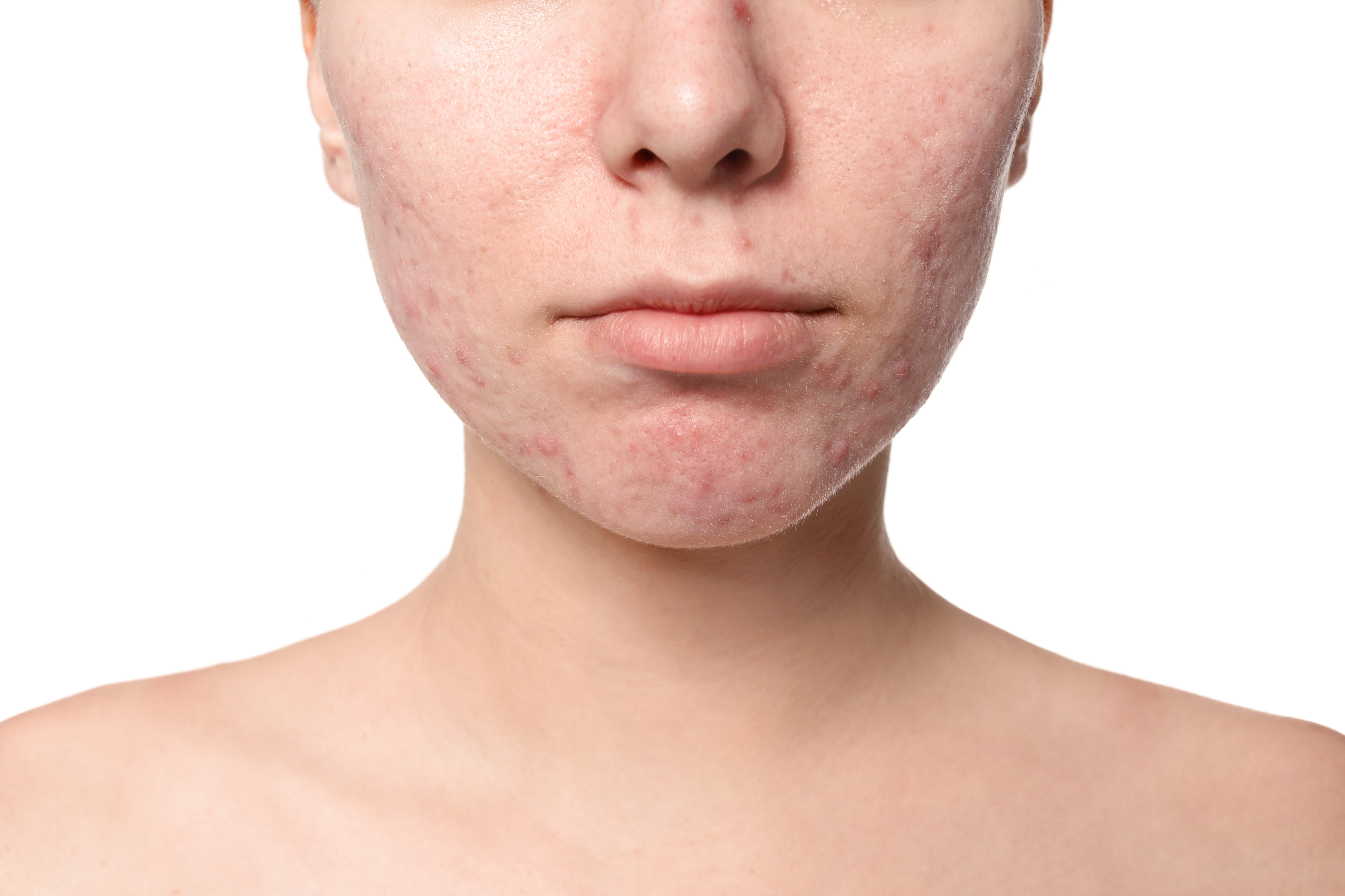 https://0901.nccdn.net/4_2/000/000/071/260/Canva---Young-woman-with-acne-problem-on-white-background-6720x4480.jpg