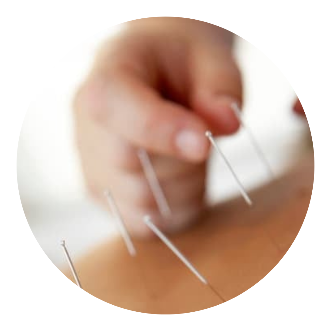 treatment acupuncture