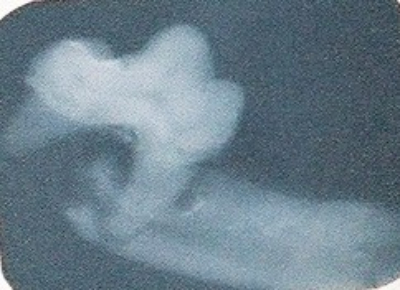An older Xray showing a broken jaw from a tooth root abcess