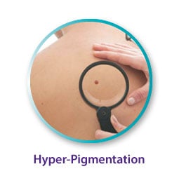Hyper-Pigmentation