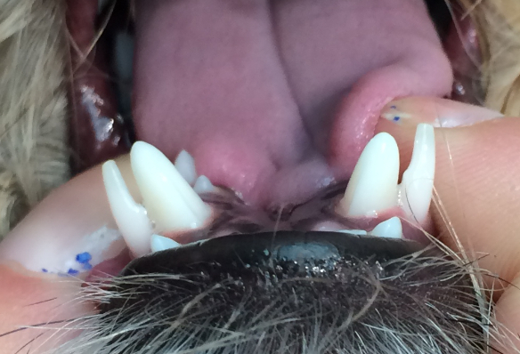Retained baby teeth causing adult teeth to be too narrow